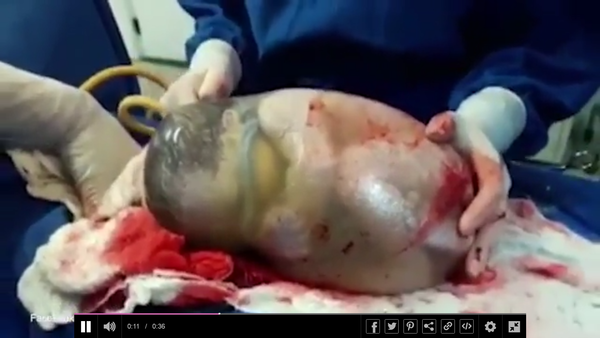 Video dieťatka, ktoré sa narodilo vo vnútri plodového vaku, sa stalo virálnym